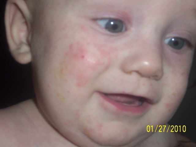 And his face. teething rash on face pictures. And his face.